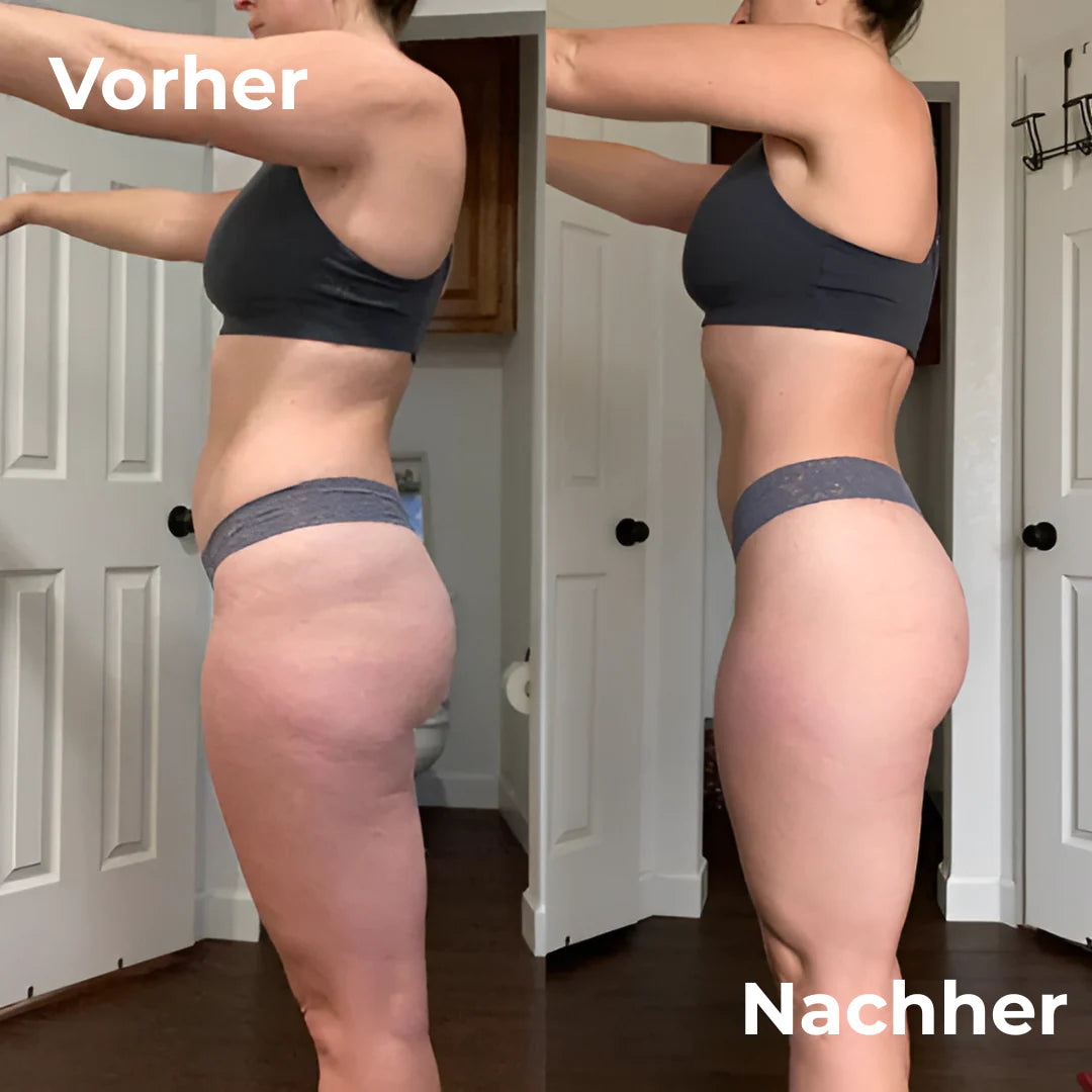 SculptRoll™ | Cellulite-Roller